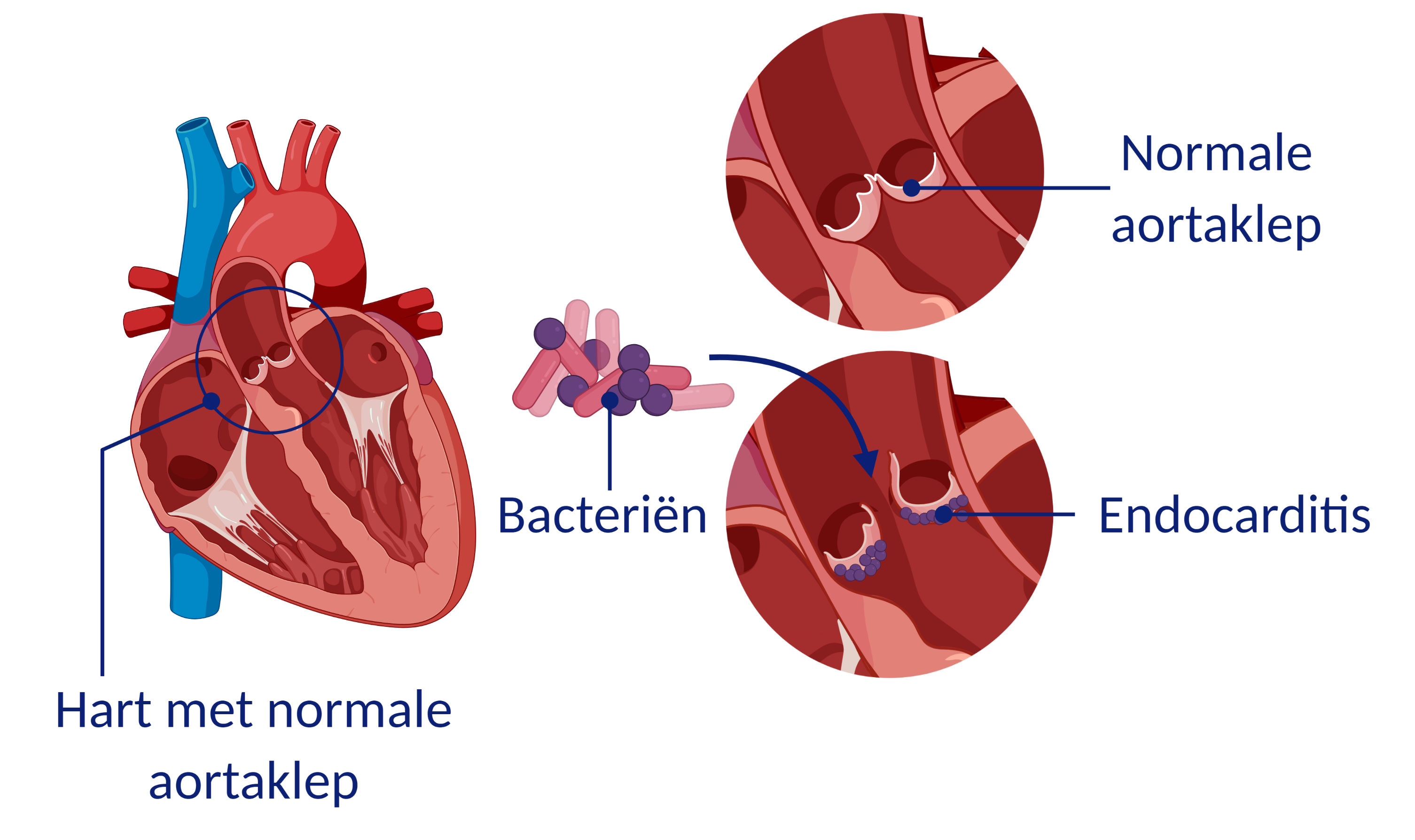 Endocarditis, een hart met een normale aortaklep en een aortaklep met endocarditis